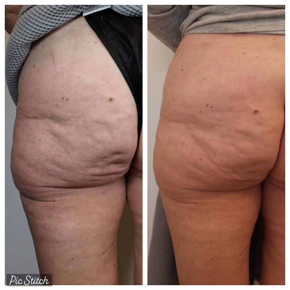 Evolvex Before and after treatment result | Empowered Med Spa in Tacoma
