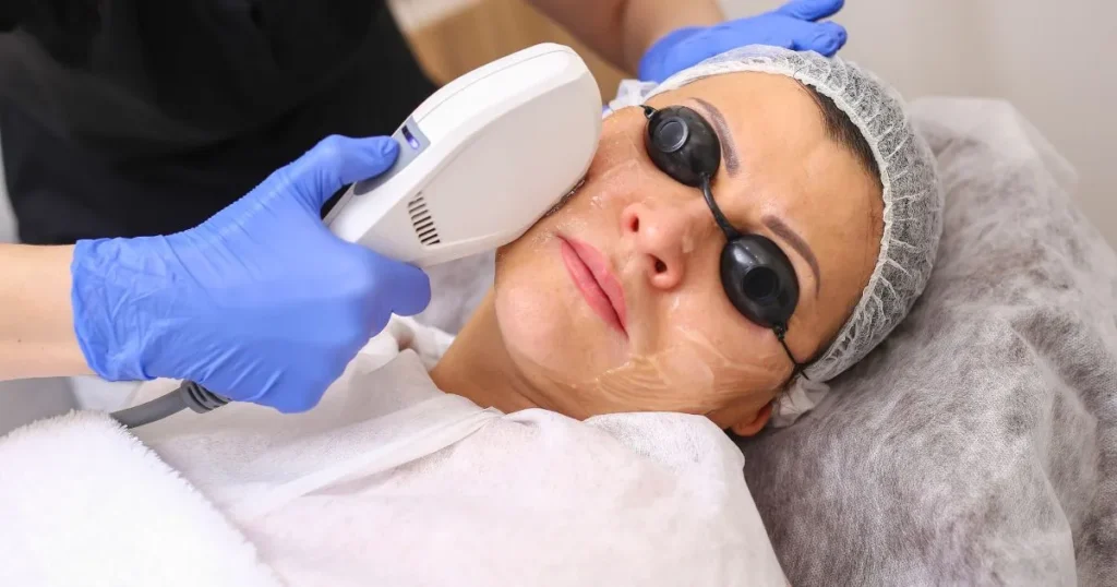 IPL Photo Facial for skin rejuvenation and sun damage treatment in Tacoma WA